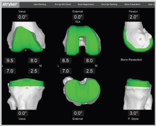 Images of Operation Plan during Total Knee Replacement