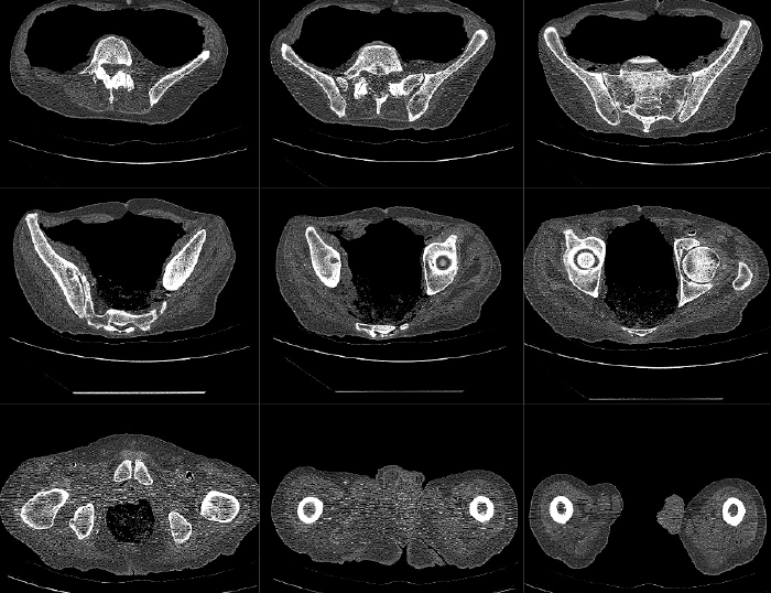 X-ray images of a patients hip