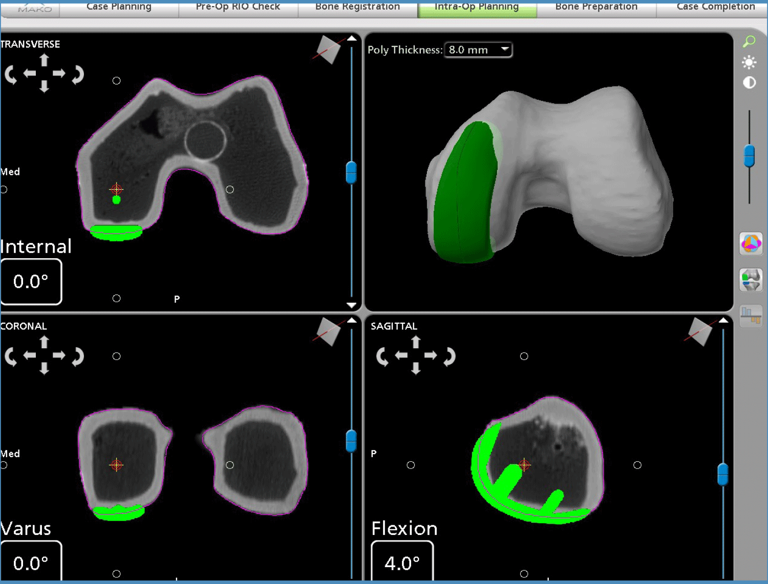 Images of Operation Plan during Total Hip Replacement