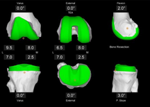 Joint Replacement