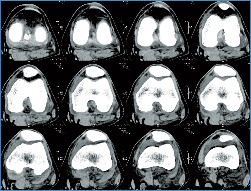  Knee CT Scan
